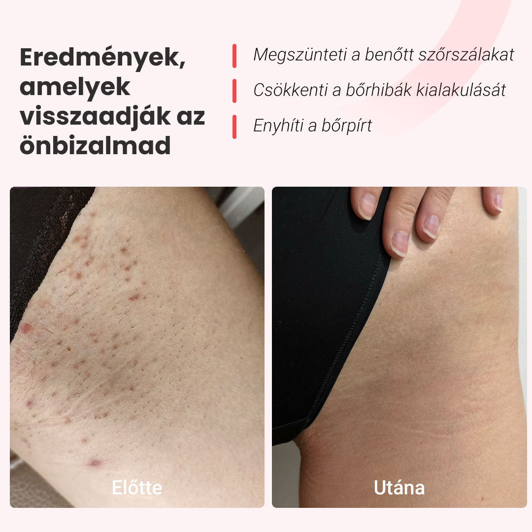 IPL szőrtelenítő készülék