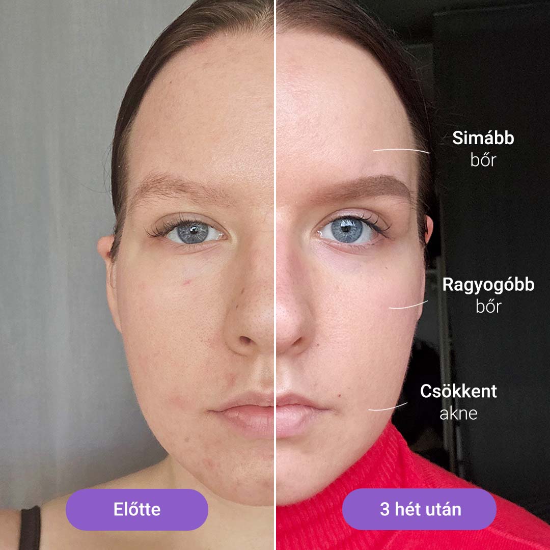 „Hilda” IPL fotoepilátor + „Lumi” fényterápiás maszk